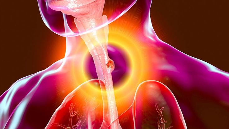 Esophageal cancer surgery by expert cancer surgeon