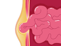 Laparoscopic hernia repair procedure