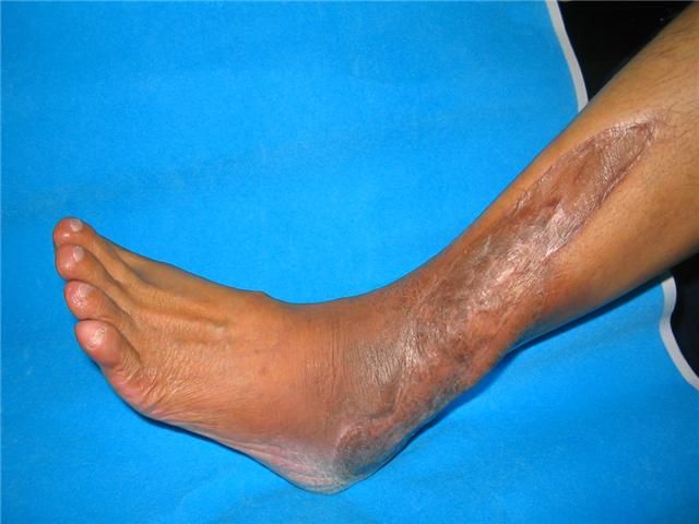 Sarcoma surgery by expert sarcoma cancer surgeon